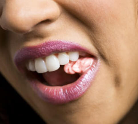 Troppi chewing gum causano emicrania